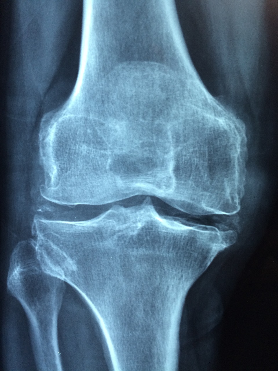 X-ray of knee joint