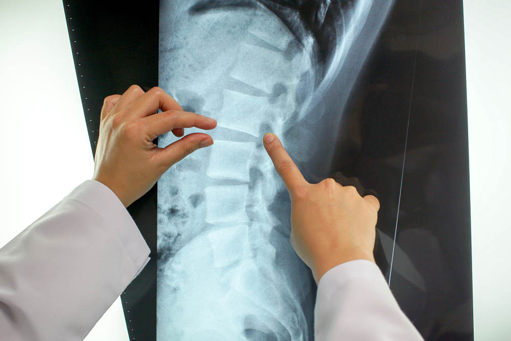epidural-steroid-injections