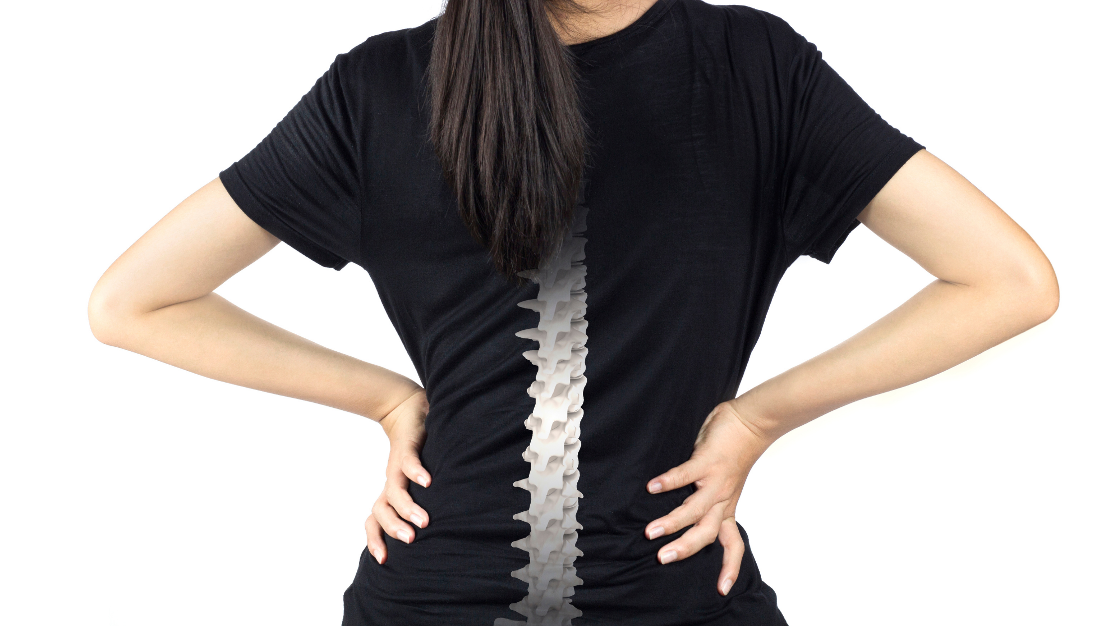woman with bone spurs in back causing sciatica