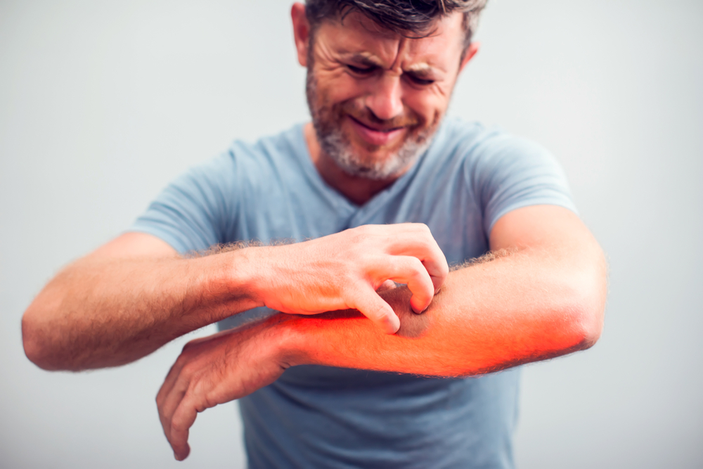 shingles rash on man's arm