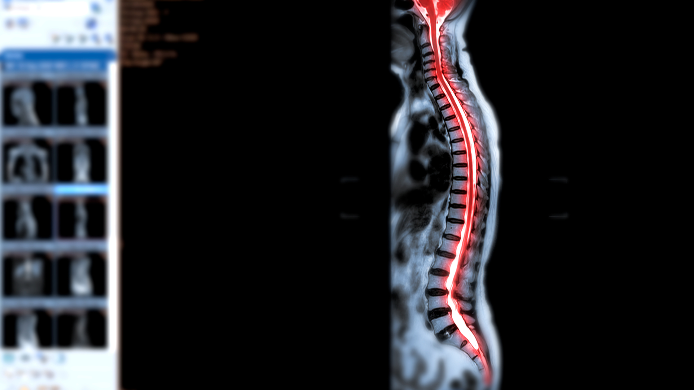 spinal cord stimulation: who can benefit?